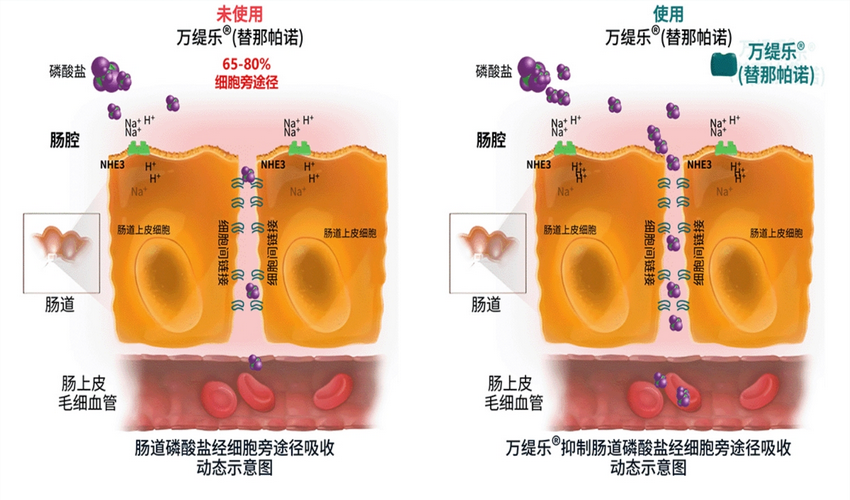 复星医药全球首个磷吸收抑制剂万缇乐®在中国获批上市
