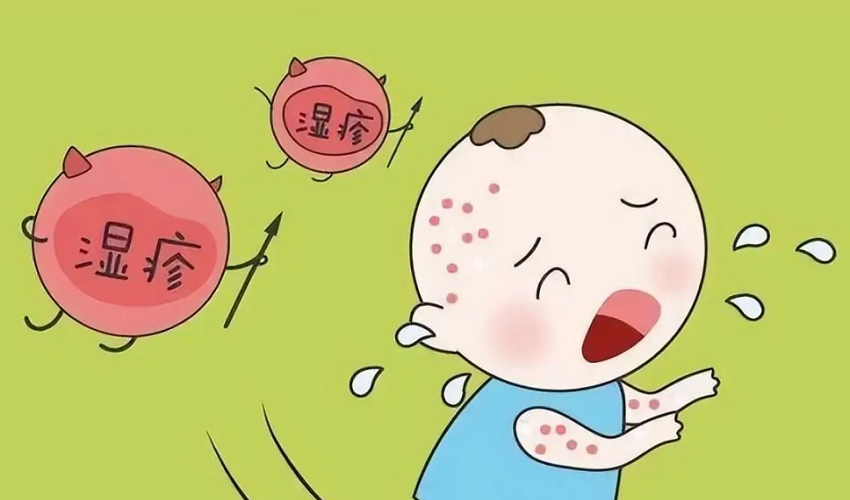 湿疹是湿气重导致的？只有过敏体质才会得湿疹吗？